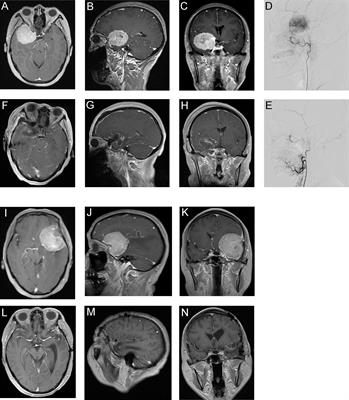 Clinical Outcomes and Complications of Preoperative Embolization for Intracranial Giant Meningioma Tumorectomy: A Retrospective, Observational, Matched Cohort Study